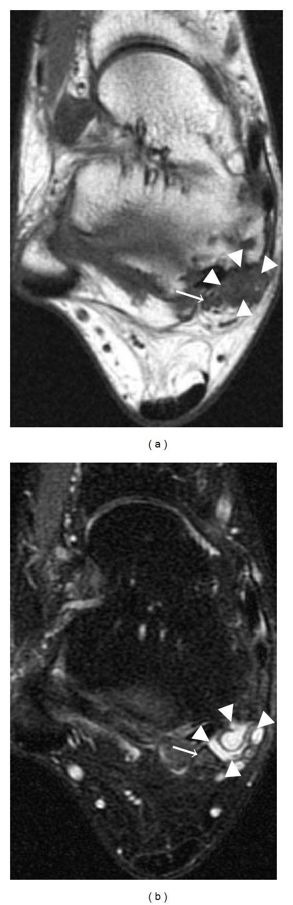 Axial ankle MRI, T1-weighted then T2 fat-saturated, showing a multilobulated synovial cyst in the tarsal tunnel, in contact with the tibial nerve indicated by an arrow.