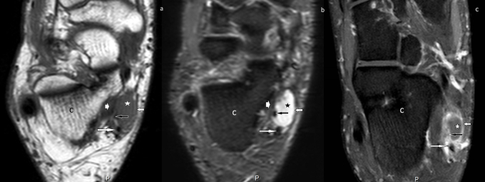 Axial foot MRI, three sequences, showing a synovial cyst with T1 hypointensity and T2 hyperintensity in contact with the flexor retinaculum, the medial plantar nerve and the posterior tibial artery in the tarsal tunnel.