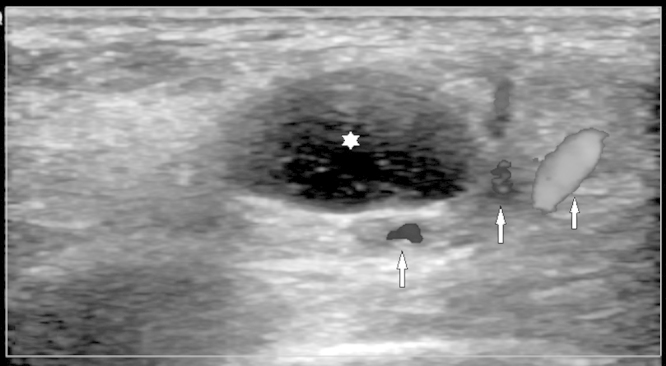 Foot ultrasound: well-circumscribed anechoic synovial cyst, arrows on the posterior tibial artery and vein in direct contact with the cyst in the tarsal tunnel.