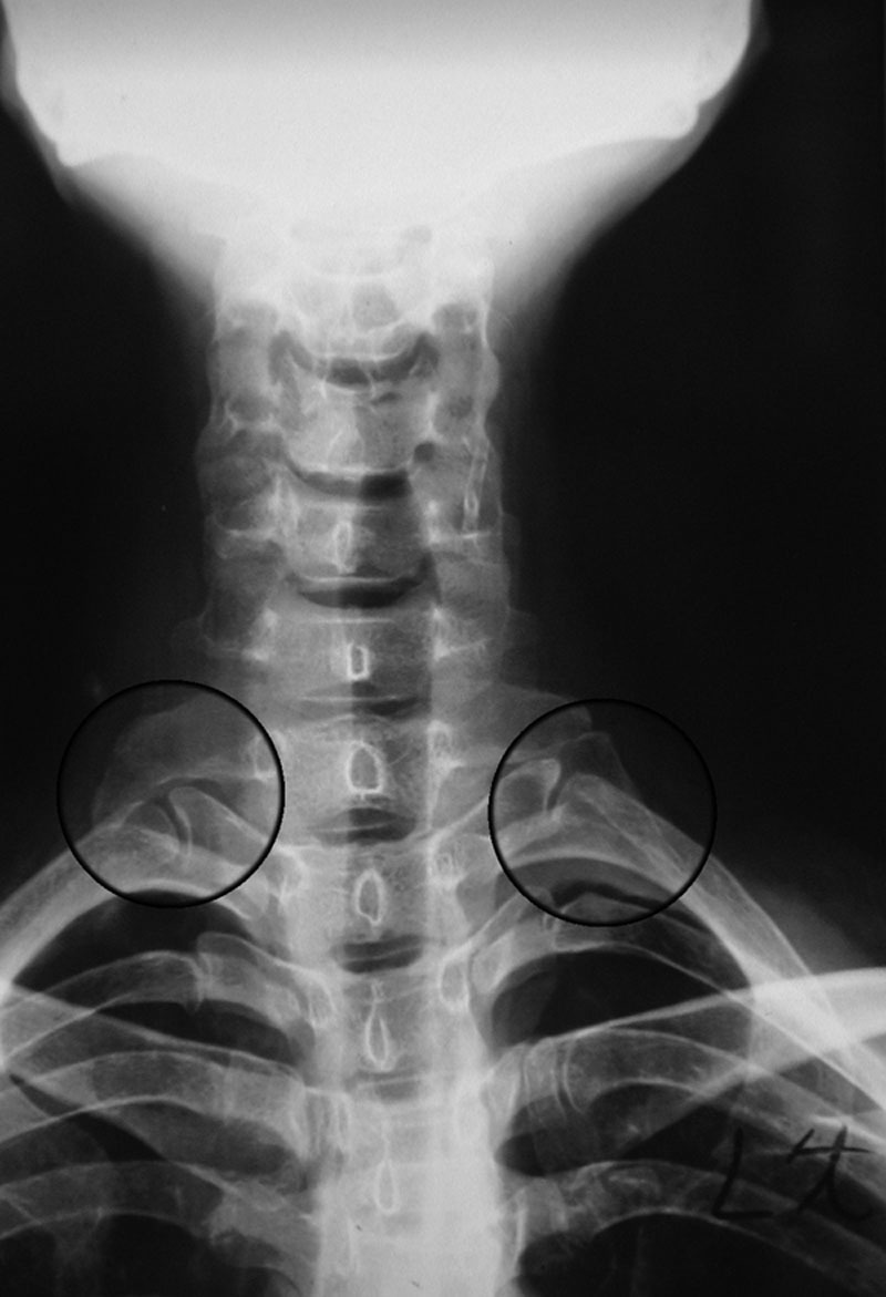 Anteroposterior cervical spine X-ray showing two bilateral supernumerary cervical ribs, circled, a classic bony cause of thoracic outlet syndrome.
