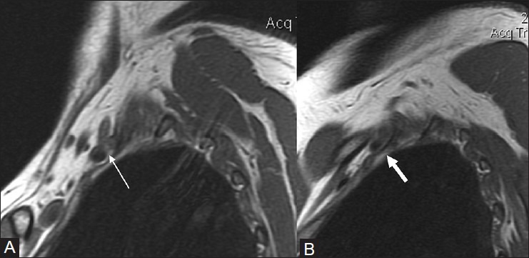 Sagittal T1-weighted shoulder MRI, comparing the arm in neutral position and hyperabduction: compression of the subclavian artery and brachial plexus in the costoclavicular space due to a cervical rib.