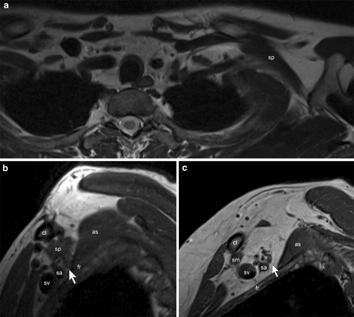 3-tesla brachial plexus MRI, arm adducted, axial section (a) and sagittal sections (b, c): an accessory subclavius posticus muscle (sp) in contact with the subclavian artery and brachial plexus in the costoclavicular space, arrows.