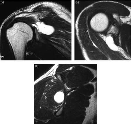 T2-weighted left shoulder MRI, coronal, axial and sagittal sections: synovial cyst of the spinoglenoid notch, with oedema and atrophy of the infraspinatus muscle on the sagittal section.
