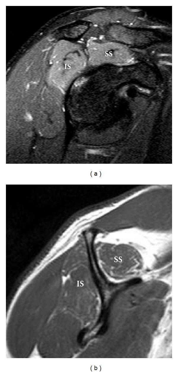 Shoulder MRI, oblique sagittal T2 fat-saturated and T1 sections: hyperintensity and atrophy with fatty infiltration of the supraspinatus and infraspinatus muscles, sequelae of suprascapular nerve injury after a swimming accident.