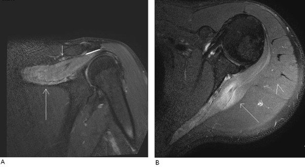 Left shoulder MRI, coronal and axial T2 fat-saturated sections: diffuse hyperintensity of the supraspinatus and infraspinatus muscles suggesting denervation, with no visible lesion at the spinoglenoid notch.