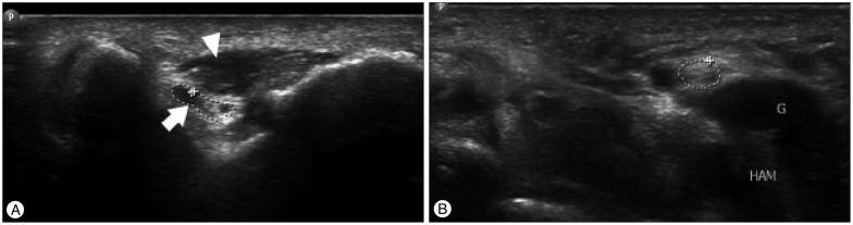 Transverse elbow ultrasound (A): the anconeus epitrochlearis muscle, a supernumerary anatomical variant, in direct contact with a swollen ulnar nerve, a mechanism of cubital tunnel compression, synovial cyst in contact with the ulnar nerve at the wrist (B).