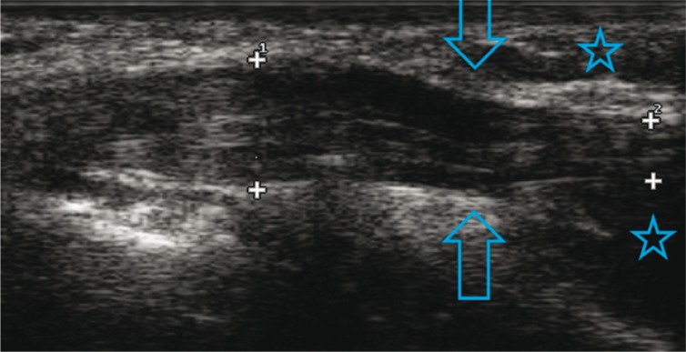Longitudinal ultrasound of the ulnar nerve at the elbow: a focal notch in the nerve, the notch sign, an ultrasound sign of cubital tunnel compression.