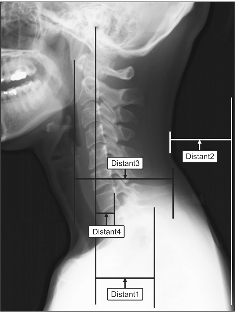 Lateral cervical spine X-ray: four horizontal distances measured between the ear, shoulder and cervical vertebrae, to quantify forward head projection.