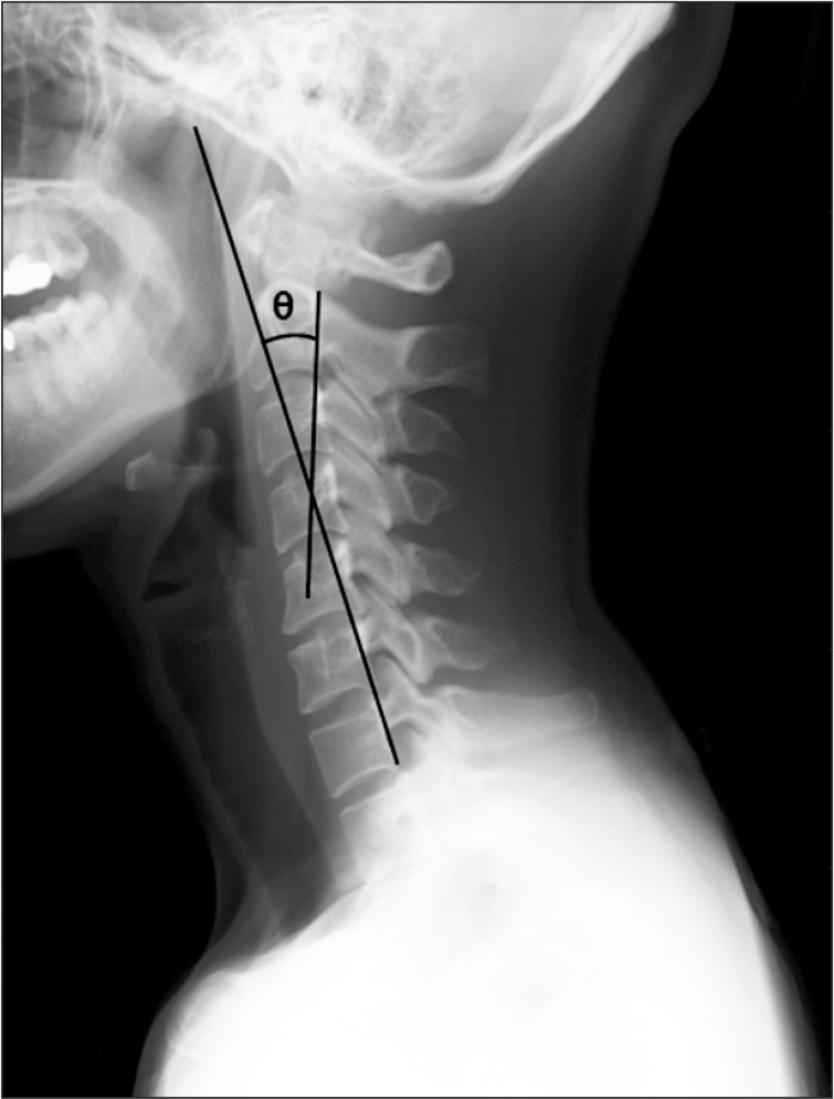 Lateral cervical spine X-ray: measurement of the cervical lordosis angle between C2 and C7 using the posterior tangent method, reduced in forward head posture.