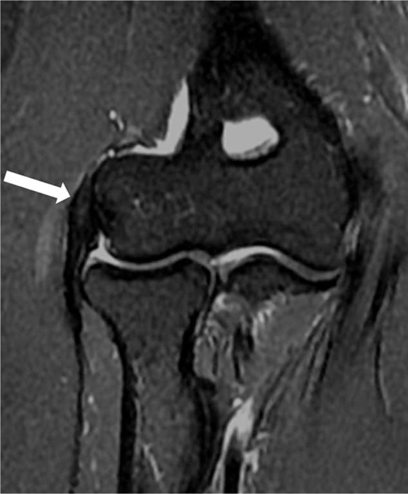 Coronal T2 fat-suppressed elbow MRI: early focal hyperintensity of the common extensor tendon at its insertion on the lateral epicondyle, arrow.