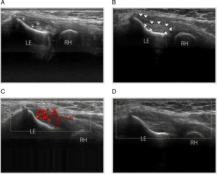 Longitudinal elbow ultrasound: irregular structure and hypoechoic focus of the extensor carpi radialis tendon, with hypervascularity on power Doppler.