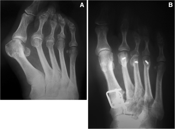 Radiographie du pied droit de face avant (A) et après (B) chirurgie : subluxation de la première et luxation des deuxième et troisième articulations métatarso-phalangiennes, corrigées par ostéotomies des métatarsiens latéraux et arthrodèse du premier rayon.