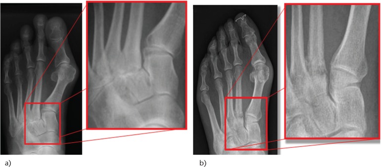 Radiographie du pied avec agrandissements : arthrose de la deuxième articulation tarso-métatarsienne et fracture de fatigue du deuxième métatarsien, signes indirects d'insuffisance du premier rayon pouvant s'associer à une griffe des orteils.
