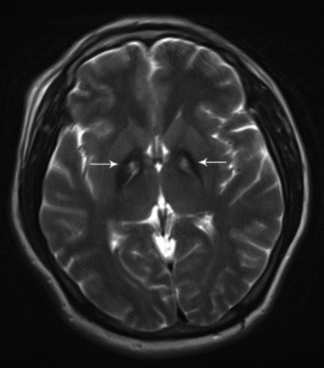Axial T2-weighted brain MRI: symmetrical hypointensity of the globus pallidus with central hyperintensity, the eye-of-the-tiger sign, arrows.