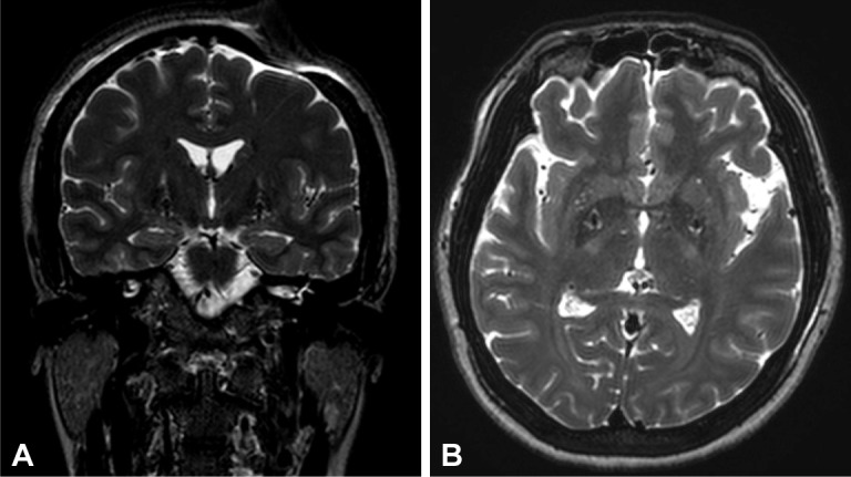 Postoperative coronal and axial T2-weighted brain MRI: trajectories of deep brain stimulation electrodes implanted bilaterally in the internal globus pallidus, in a patient with segmental dystonia (Meige syndrome).