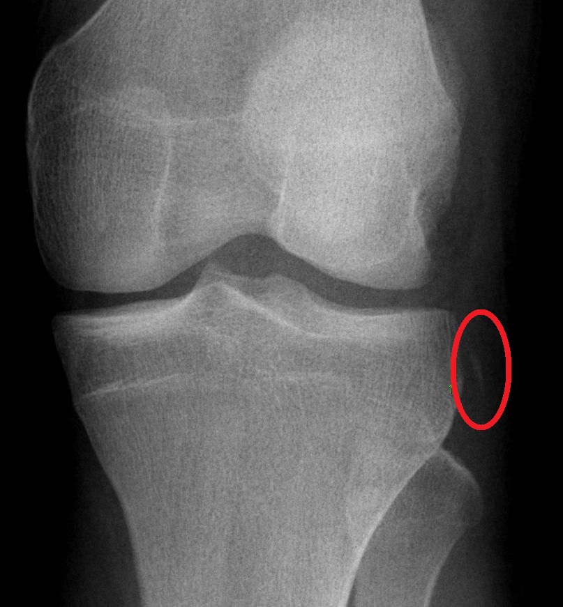 Anteroposterior knee X-ray: a small bone fragment avulsed from the lateral tibial plateau (Segond sign, circled), an indirect radiographic sign of anterior cruciate ligament rupture.