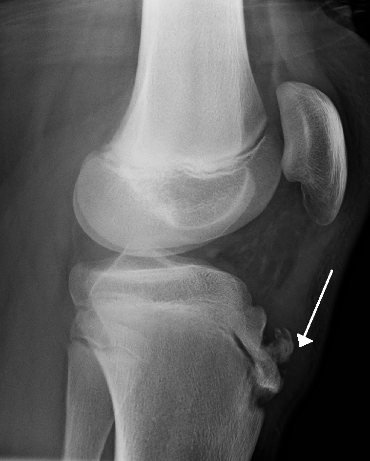 Lateral knee X-ray: fragmentation of the anterior tibial tubercle with overlying soft tissue swelling, characteristic of Osgood-Schlatter disease.