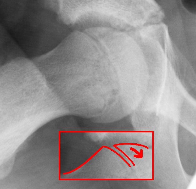 Anteroposterior hip X-ray with Klein's line drawn: slippage of the upper femoral epiphysis relative to the metaphysis, a sign of slipped capital femoral epiphysis.