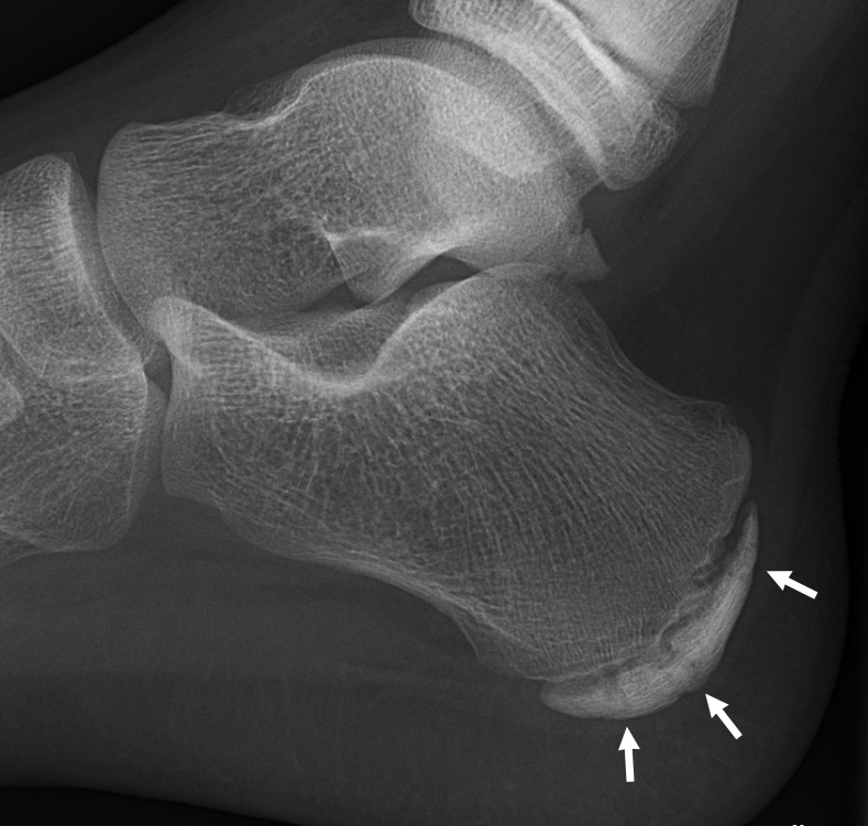 Lateral foot X-ray in an 11-year-old boy: sclerosis and fragmentation of the calcaneal apophysis, an appearance suggestive of Sever's disease.