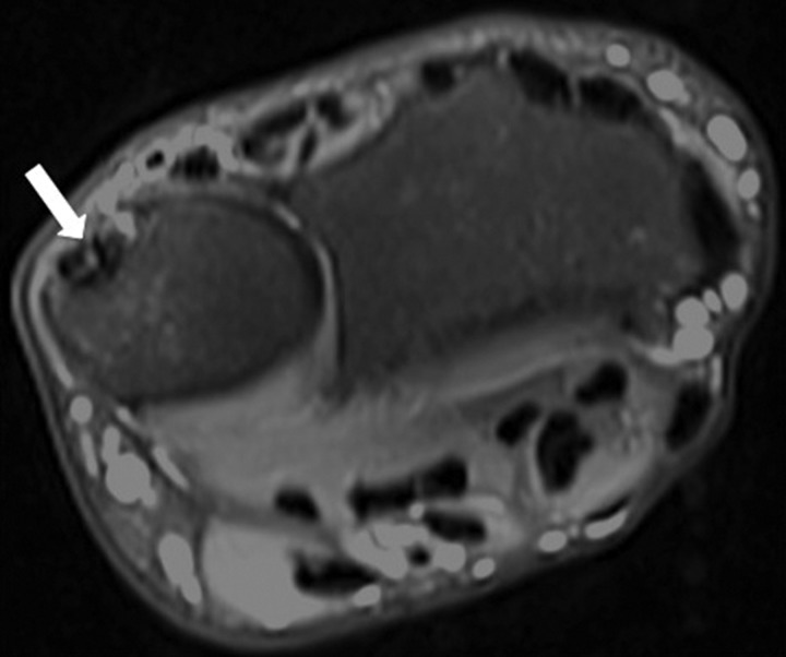 Axial fat-saturated T2-weighted wrist MRI: longitudinal tear of the extensor carpi ulnaris tendon, arrow on the area of hyperintensity.