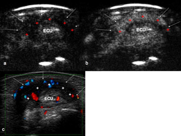 Transverse ultrasound of the wrist over the extensor carpi ulnaris (ECU) tendon, showing peritendinous effusion and vascularity associated with tenosynovitis.