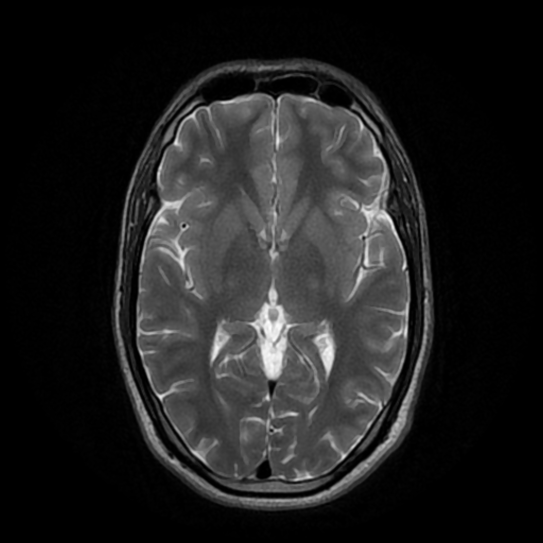 IRM cérébrale en coupe axiale, pondération T2, sans anomalie visible : illustre l'imagerie normale attendue dans les troubles fonctionnels neurologiques.