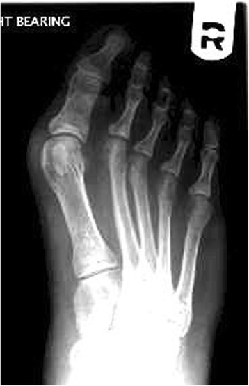 Radiographie du pied droit en charge, incidence dorso-plantaire : déviation latérale marquée du gros orteil et angle intermétatarsien augmenté, déformation typique de l'hallux valgus.