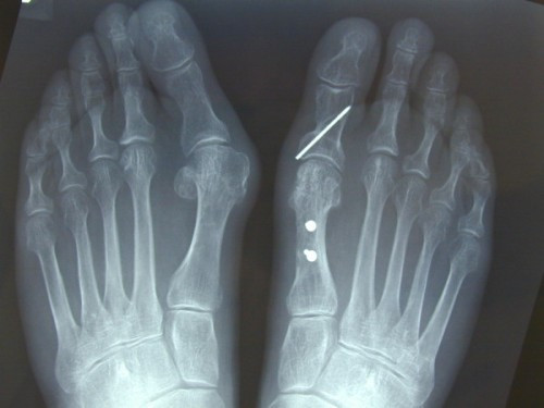 Radiographie des deux pieds de face : hallux valgus non opéré d'un côté, et pied droit corrigé par ostéotomies scarf et Akin, vis de fixation visibles, alignement du premier rayon restauré.