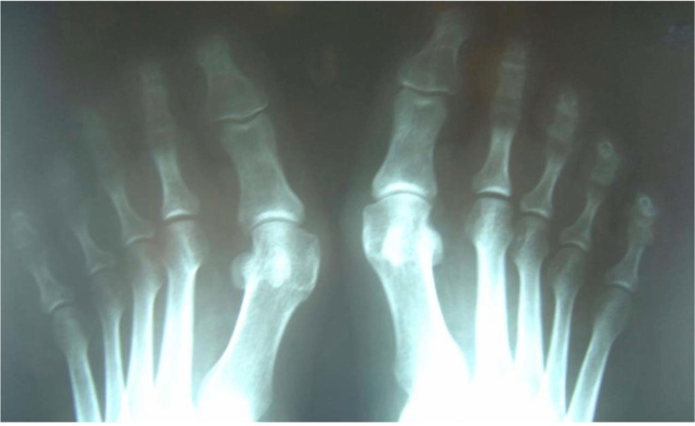 Radiographie des deux pieds de face : hallux valgus bilatéral et symétrique, déviation du gros orteil visible des deux côtés.