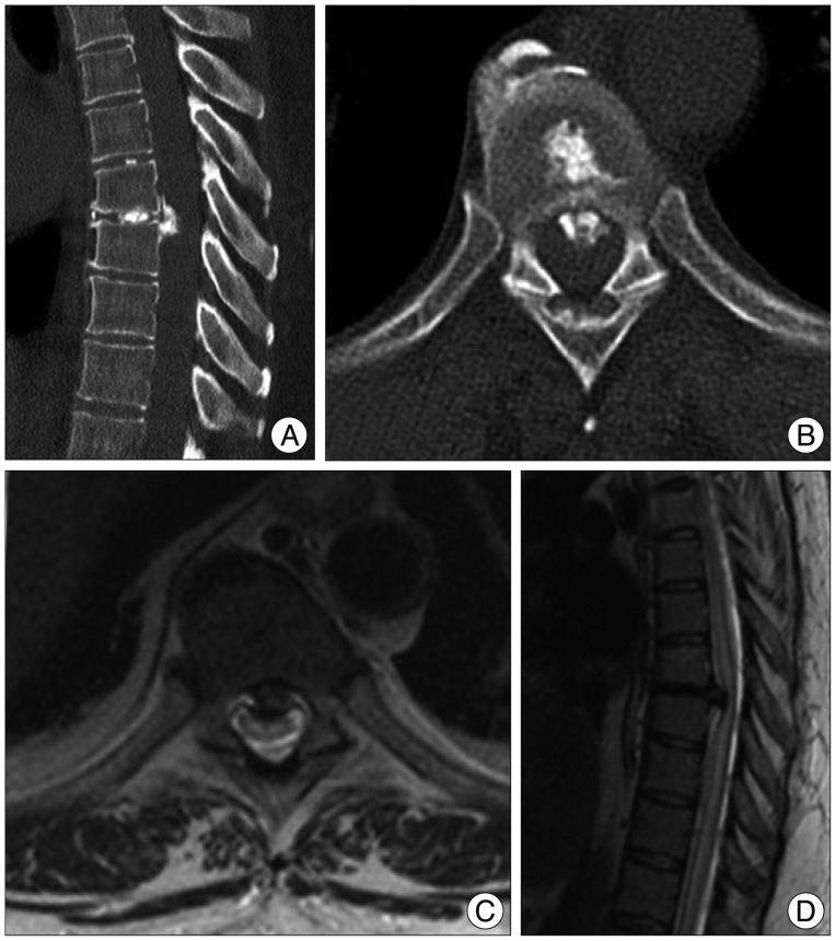 CT (A, B) and MRI (C, D) of the thoracic spine showing a large, calcified, midline disc herniation at T7-T8, with cord compression clearly visible on the images.