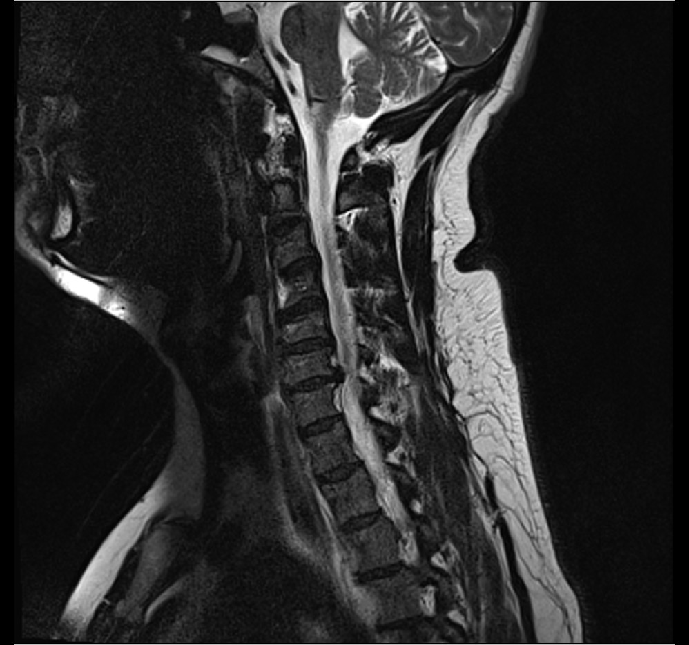 Sagittal T2-weighted cervical spine MRI showing a disc herniation at C6-C7.