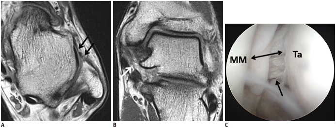 IRM de cheville en coupes axiale et coronale oblique, avec corrélation arthroscopique : rupture chronique du ligament talo-fibulaire antérieur et amincissement du ligament deltoïdien superficiel, avec élargissement de la mortaise interne.