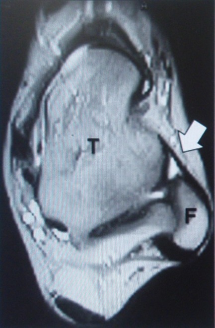 IRM de cheville en coupe axiale pondérée T2 : ligament talo-fibulaire antérieur aminci et remanié, repéré entre le tibia et la fibula, mesuré avant chirurgie pour instabilité chronique de la cheville.