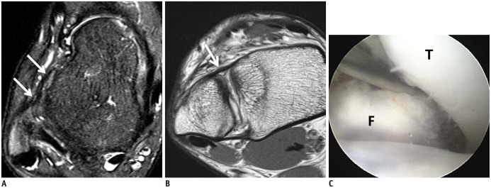 IRM de cheville en coupes axiales, avec corrélation arthroscopique : ligament talo-fibulaire antérieur et ligament tibio-fibulaire antéro-inférieur lâches et irréguliers, témoins d'une instabilité chronique, avec élargissement de l'articulation tibio-fibulaire distale confirmé en arthroscopie.