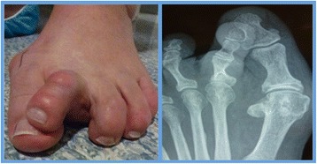 Photographie clinique et radiographie du pied de face : déformation complexe du 2e orteil en crossover avec subluxation de l'articulation métatarso-phalangienne, visible cliniquement et radiographiquement.