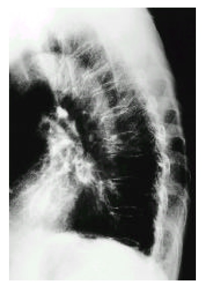 Radiographie thoracique de profil montrant des fractures-tassements vertébrales de T5 et T8 avec cyphose marquée, typiques de l'ostéoporose sévère.