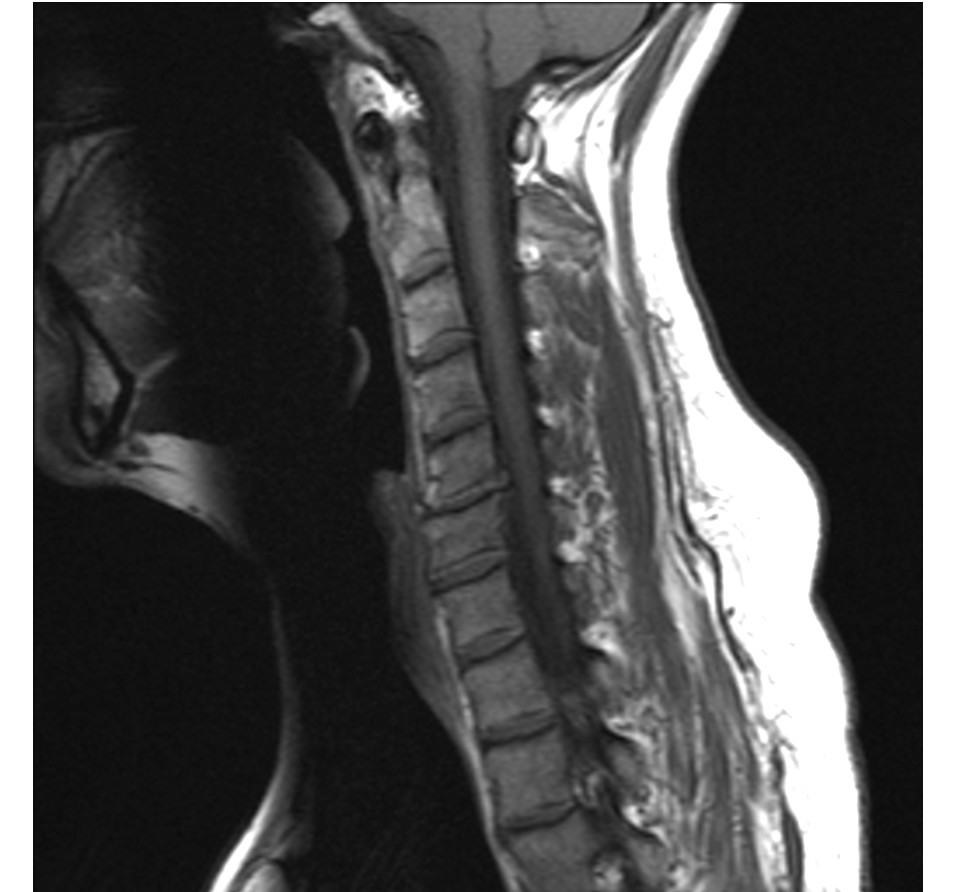 MRI of the cervical spine, sagittal view, T1 sequence: degenerative disc disease with osteophytes and osteoarthritis at C4-C5.