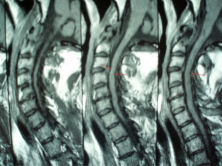 MRI of the cervical spine, series of sagittal slices: spinal cord compression at C3-C4 due to cervical spondylosis, arrows at the point of compression.