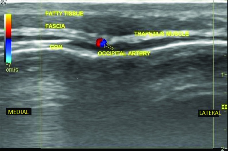 Échographie du nerf grand occipital repéré par rapport à l'artère occipitale, au tissu graisseux, au fascia et au muscle trapèze.