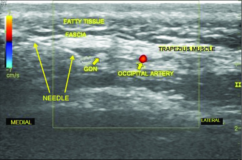 Échographie montrant l'aiguille placée contre le nerf grand occipital juste avant l'injection d'anesthésiant et de corticoïde, lors d'un bloc nerveux échoguidé.