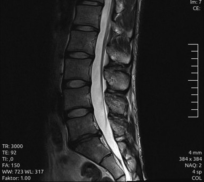 IRM lombaire en coupe sagittale, séquence T2 : discopathie dégénérative sévère (Pfirrmann grade 4) en L5-S1 avec protrusion discale, sans compression radiculaire.