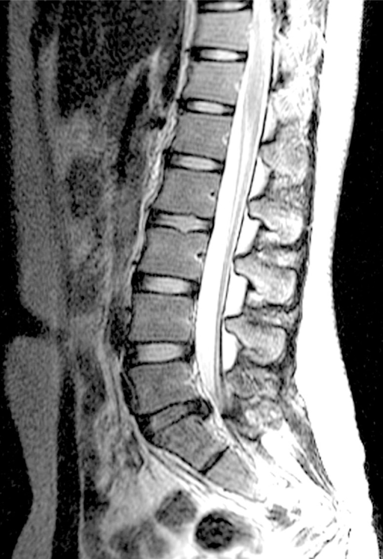 IRM lombaire en coupe sagittale, séquence T2 : hernie discale L5-S1 avec protrusion comprimant le fourreau dural, sur fond de discopathie dégénérative.