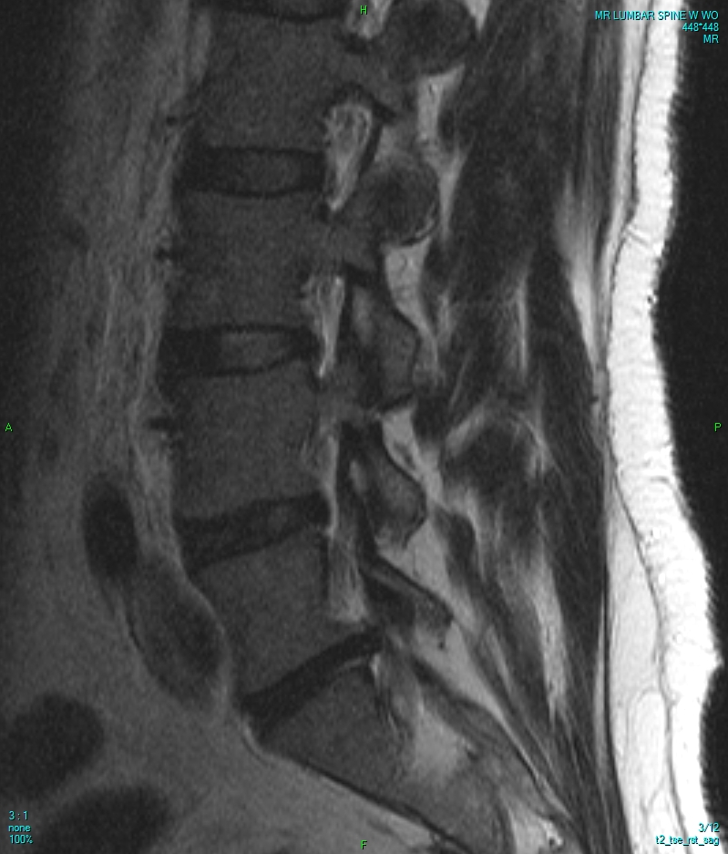 IRM lombaire en coupe sagittale, séquence T2 : perte de signal et pincement des disques lombaires bas, aspect de discopathie dégénérative étagée.