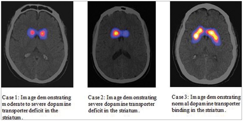 Brain scintigraphy (DAT-SPECT): moderate to severe deficit of dopamine transporter uptake in the striatum, compared with normal uptake, a characteristic sign of Parkinson's disease.