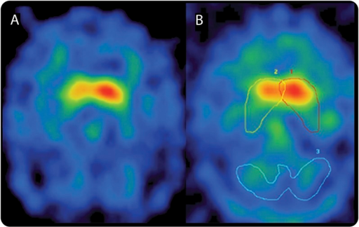 Brain scintigraphy (DAT-SPECT), transaxial view: decreased and asymmetric striatal uptake, with more pronounced loss in the putamen, in a patient with Parkinson's disease.