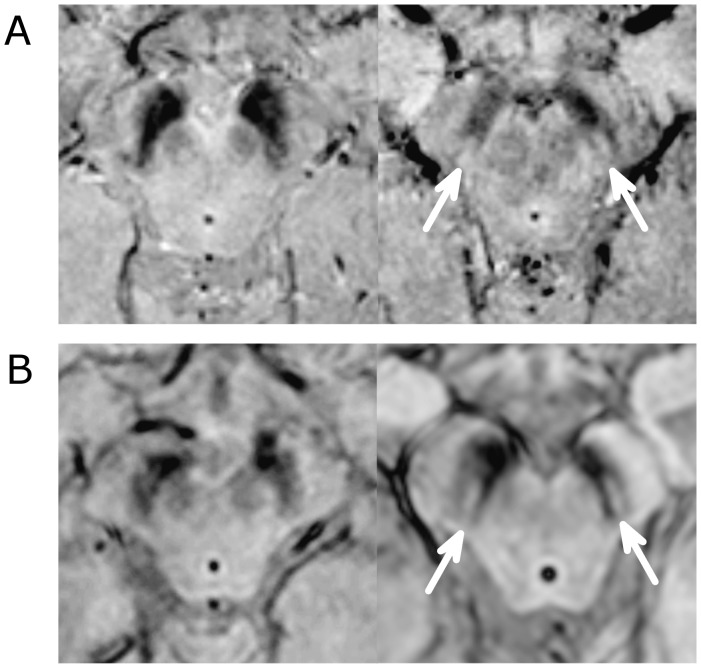 Brain MRI, high-resolution gradient-echo (SWI) sequence, axial view at the level of the midbrain: loss of the swallow tail sign (nigrosome-1) on the left in a patient with Parkinson's disease, present on the right in a healthy control (arrows).