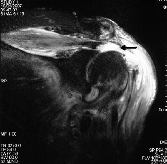 MRI of the shoulder, coronal view: full-thickness tear of the supraspinatus tendon, with high-signal fluid at the tendon insertion, arrow shown.