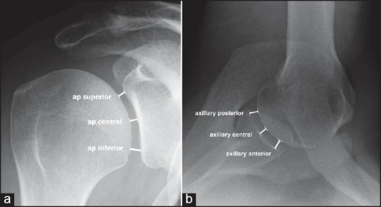 Anteroposterior and axillary shoulder radiographs: landmarks for measuring the glenohumeral joint space, a technique used to assess shoulder osteoarthritis.