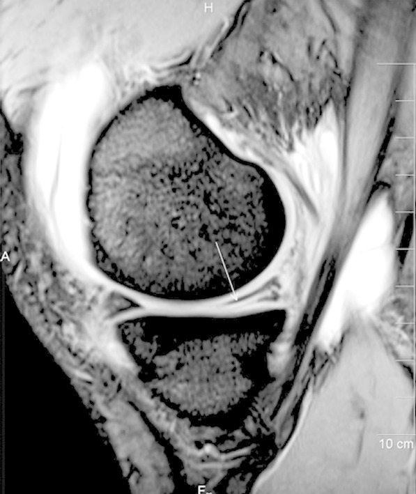 IRM du genou en coupe sagittale : rupture de grade 3 de la corne postérieure du ménisque interne, signal hyperintense linéaire atteignant la surface articulaire inférieure, avec épanchement articulaire (flèche).