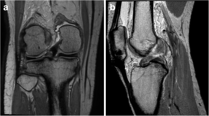 IRM du genou, deux coupes : rupture de la racine du ménisque latéral en coronal (a) et rupture du ligament croisé antérieur avec discontinuité et tuméfaction en sagittal (b).